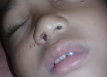 Lintah Besemayam Selama Dua Pekan pada Hidung Anak di Nagrak Sukabumi